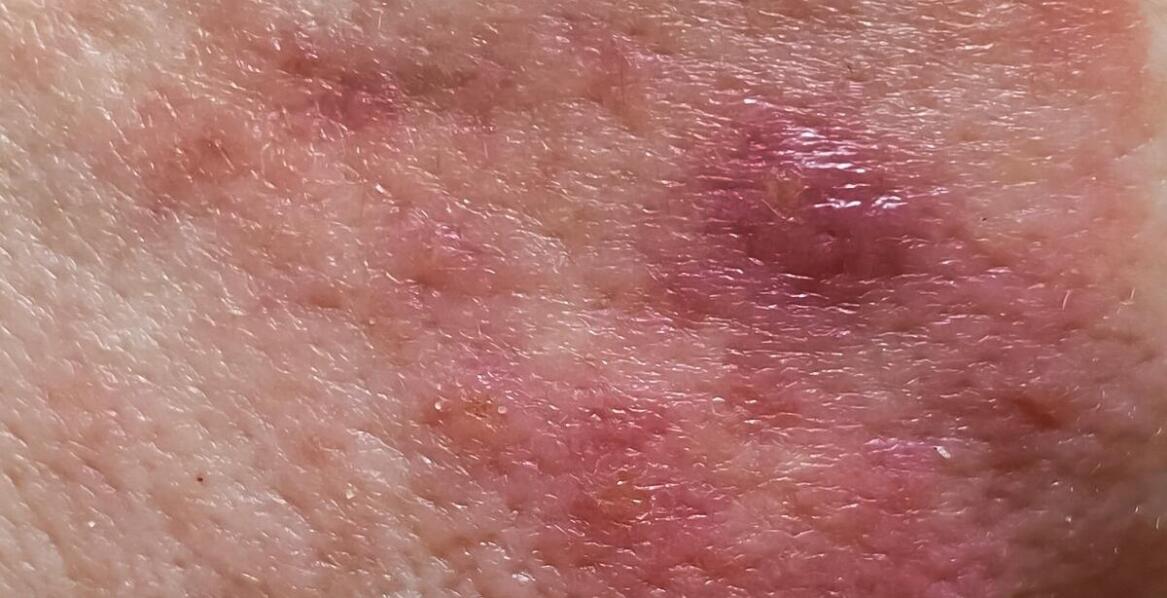 Świerzb a ukąszenia owadów – podobieństwa w objawach