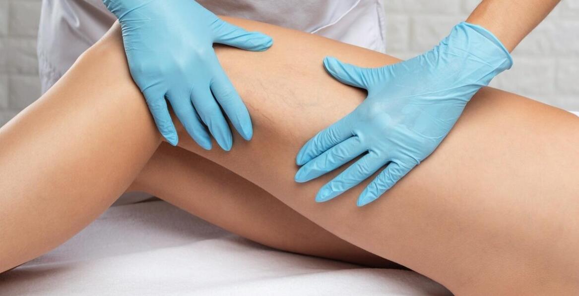 Co jest skuteczniejsze na pajączki - skleroterapia czy laser?