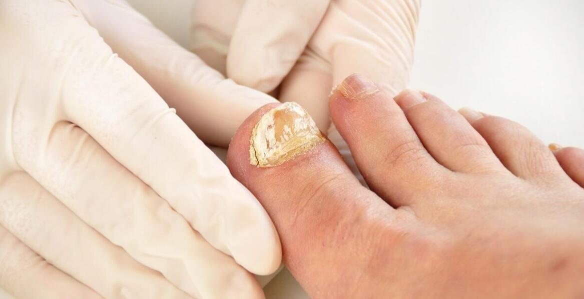 Podologiczne podejście do usuwania krwiaków podpaznokciowych