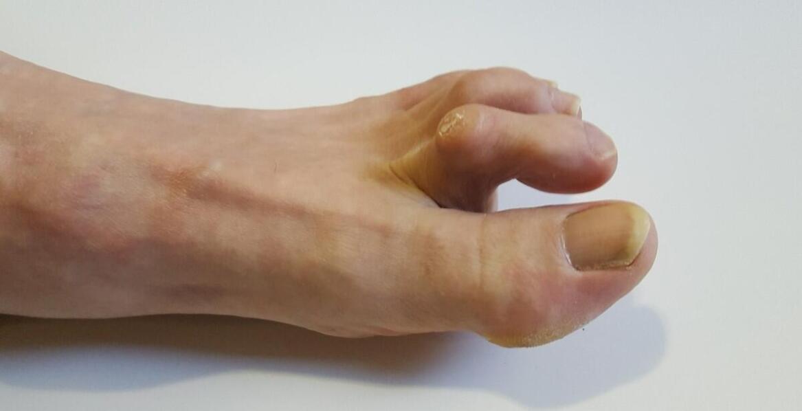 Separator na palce jako element wspierający higienę i bezpieczeństwo zabiegów