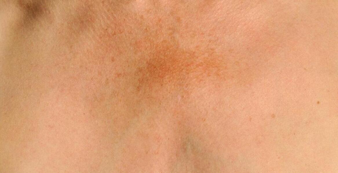 Zalety laserowego usuwania przebarwień – szybki powrót do pięknej skóry