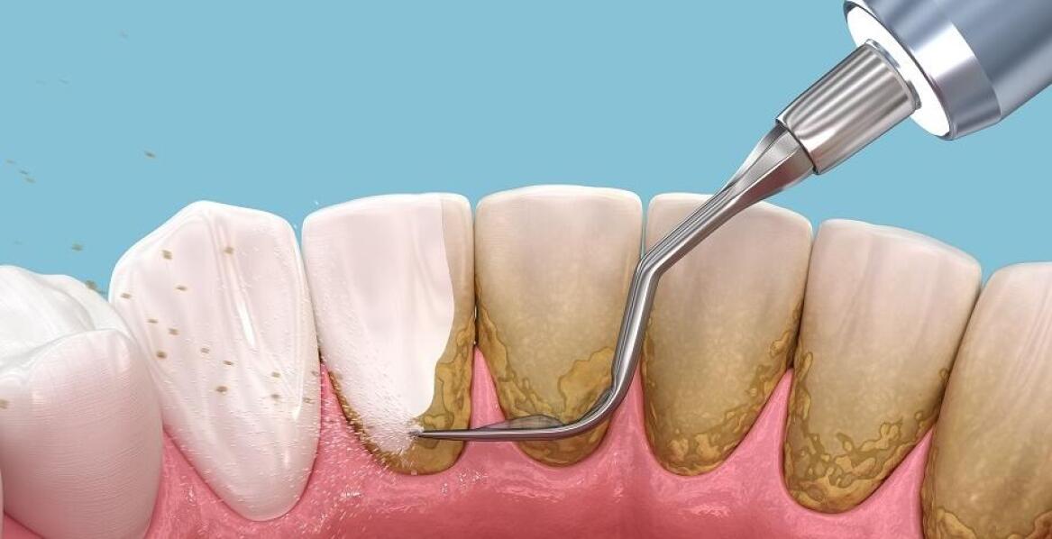 Jak piaskowanie zębów wpływa na estetykę uśmiechu?