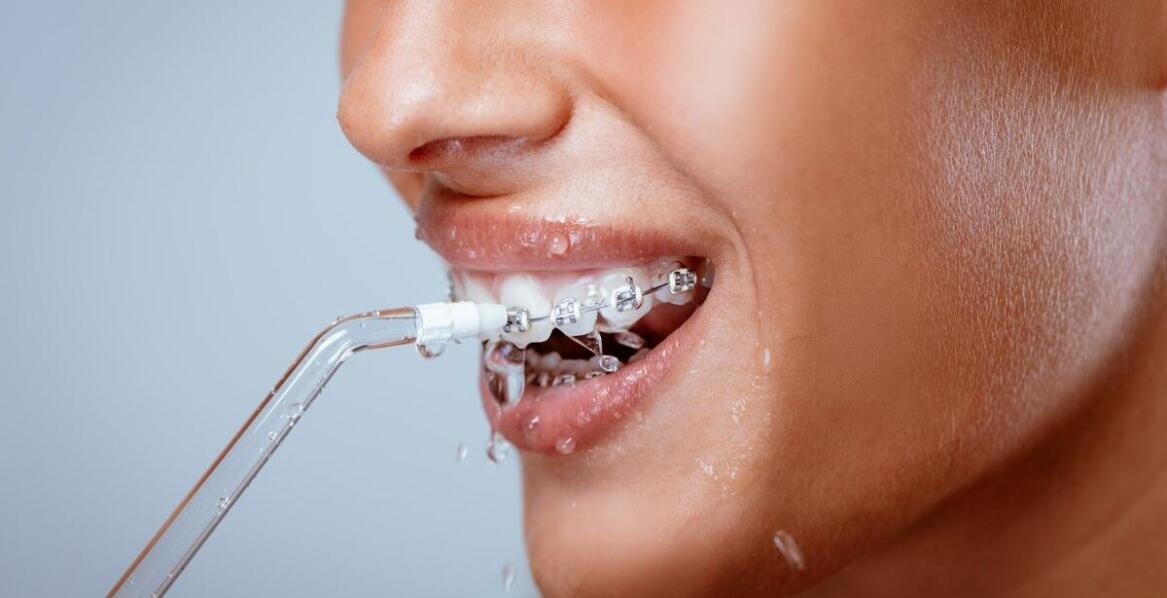 Jakie są zalecenia dotyczące pielęgnacji zębów z aparatem ortodontycznym?