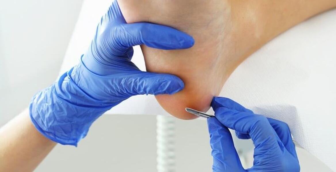 Skuteczność leczenia nadmiernej potliwości stóp w gabinecie podologicznym