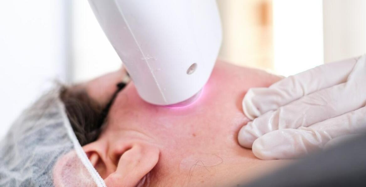 Jakie są długoterminowe efekty stosowania radiofrekwencji monopolarnej?