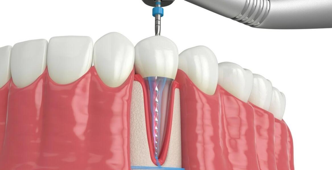 Przygotowanie podłoża kostnego pod implanty: co to jest chirurgia przedimplantacyjna?