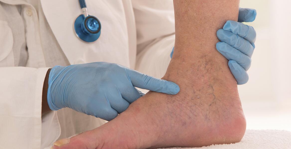 Efektywność skleroterapii w redukcji pajączków naczyniowych – co warto wiedzieć?