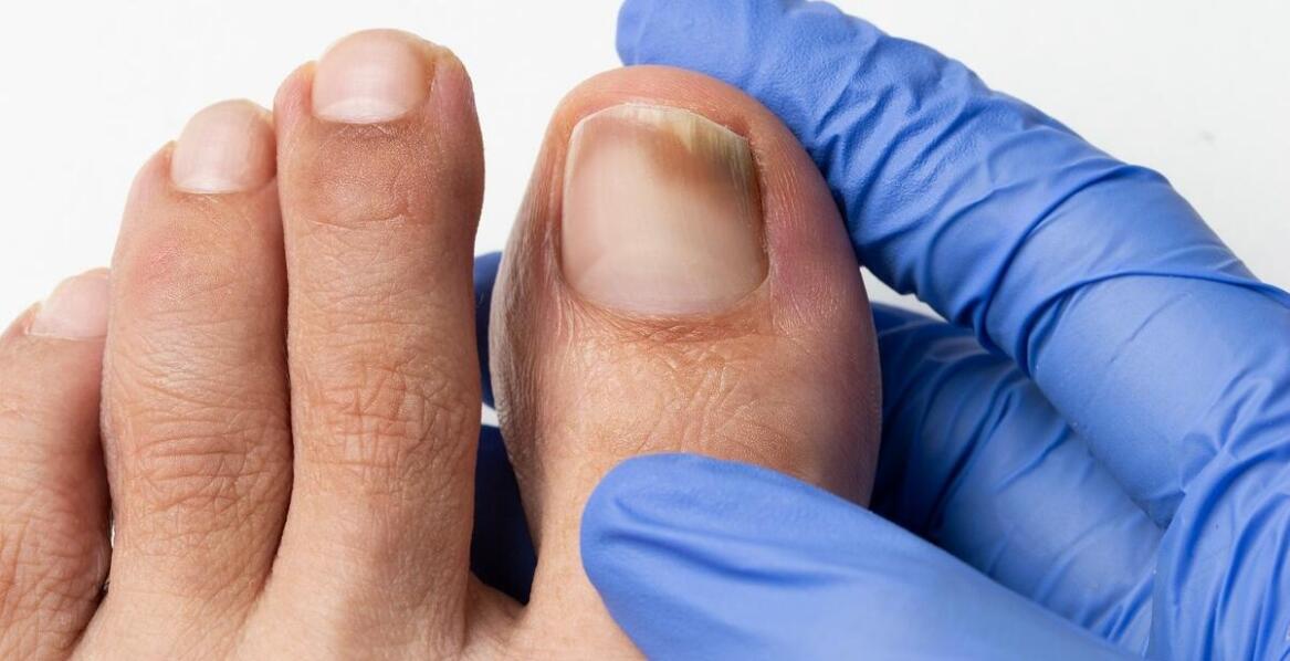 Skuteczne metody leczenia wrastających paznokci u specjalistów