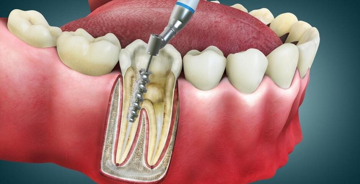Jakie korzyści płyną z wykorzystania nowoczesnych technologii w endodoncji?