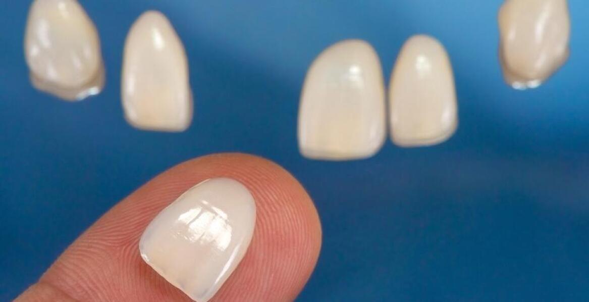 Jakie korzyści niesie ze sobą stosowanie licówek w stomatologii estetycznej?