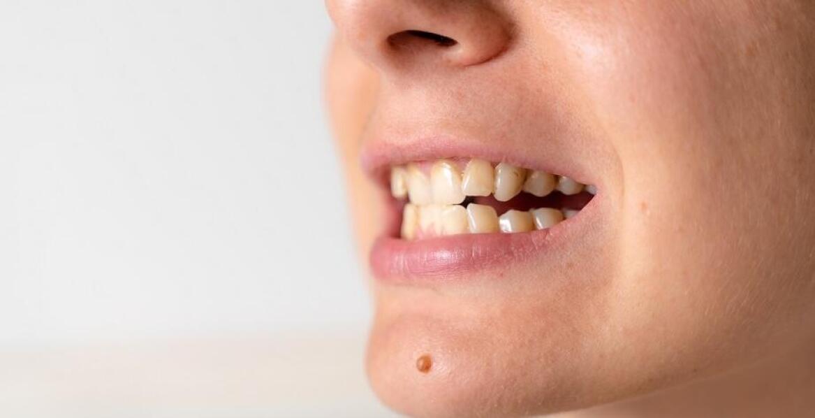 Jakie są rodzaje wad zgryzu?