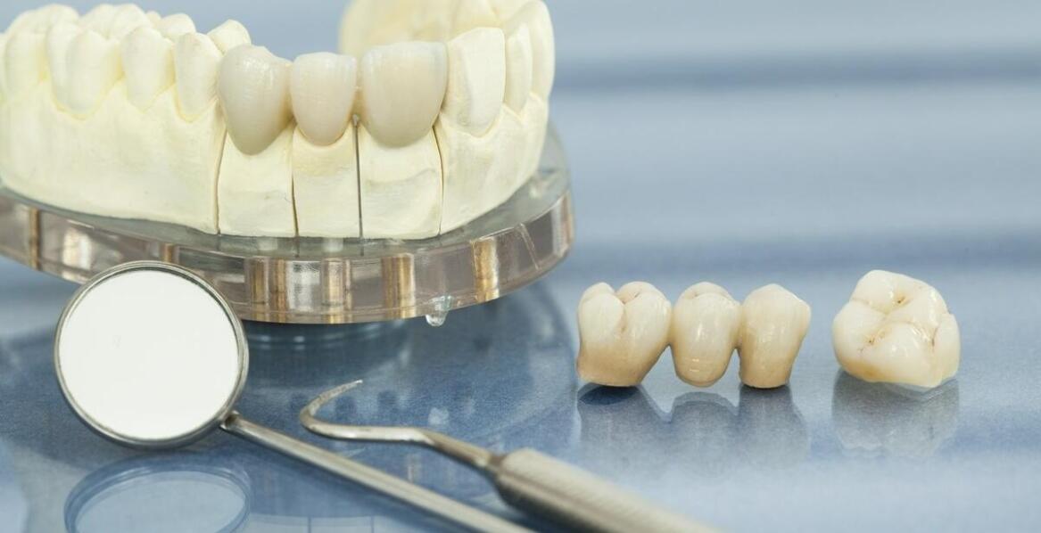 Jakie są różnice między implantami zębowymi a tradycyjnymi mostami protetycznymi?