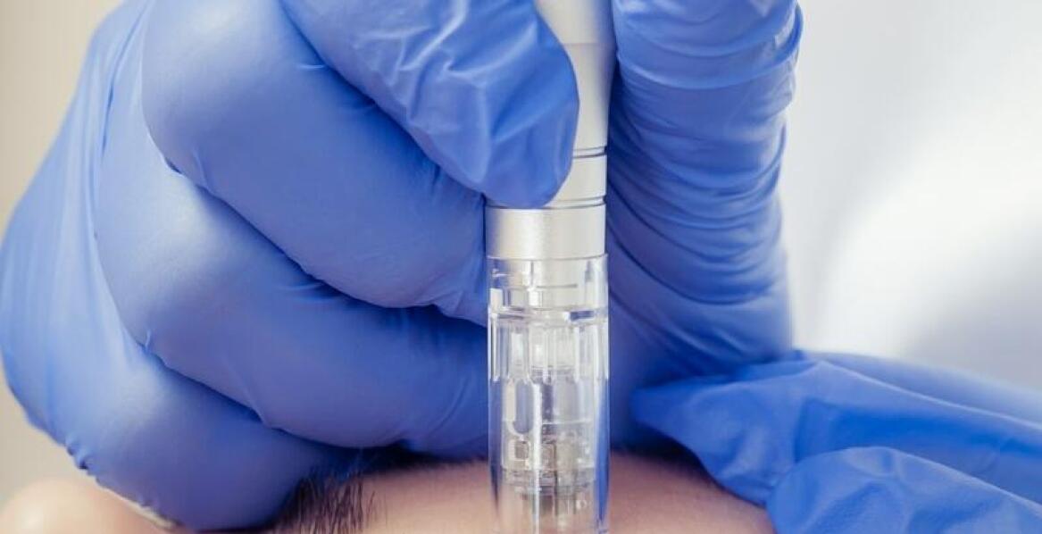 Jakie są opinie pacjentów o efektach mezoterapii mikroigłowej na rozstępy?