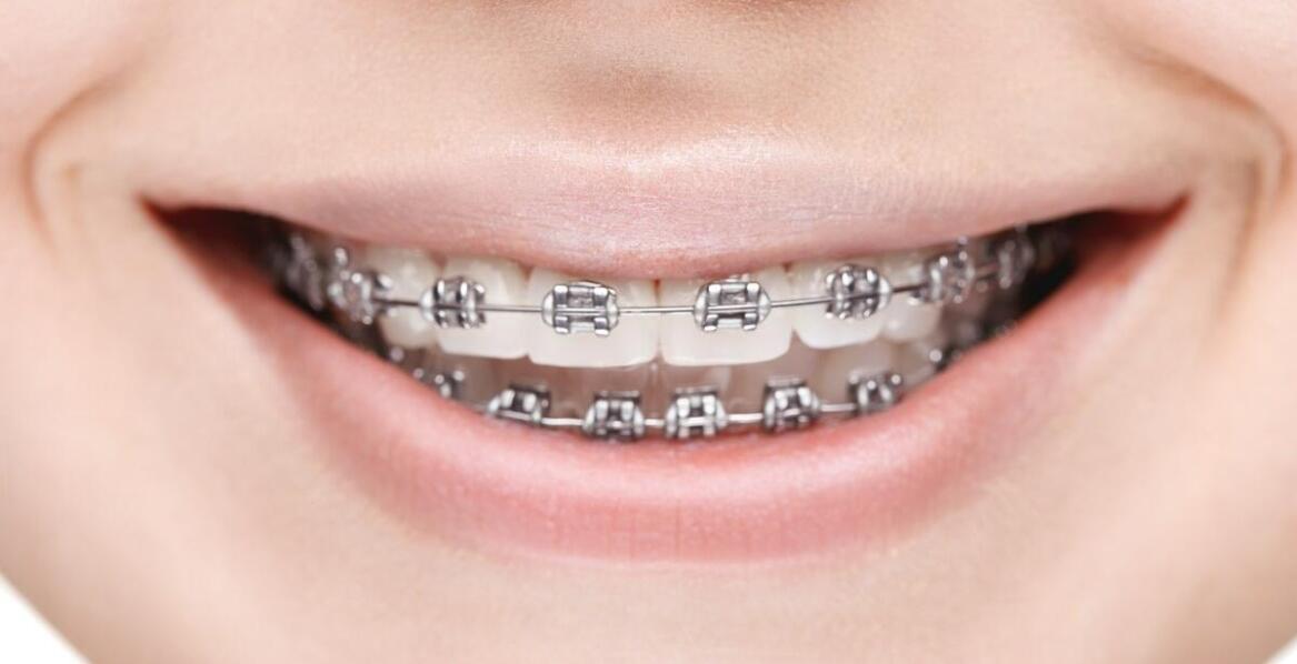 Wpływ aparatu ortodontycznego na poprawę funkcji zgryzu i mowy