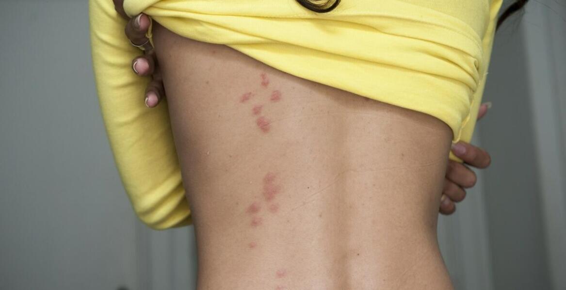 Warroza - jak ją zwalczać?