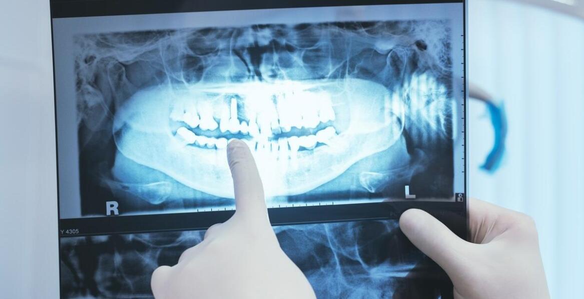 Rola RTG zębów w wykrywaniu próchnicy i chorób przyzębia