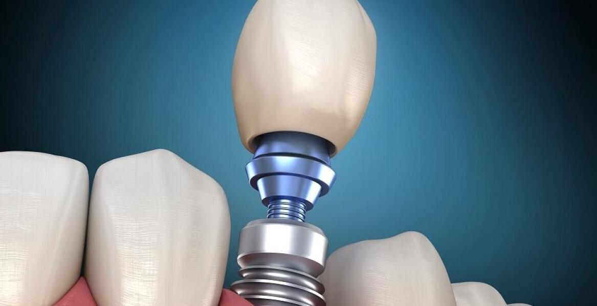 Zalety korzystania z nowoczesnych technologii w implantologii