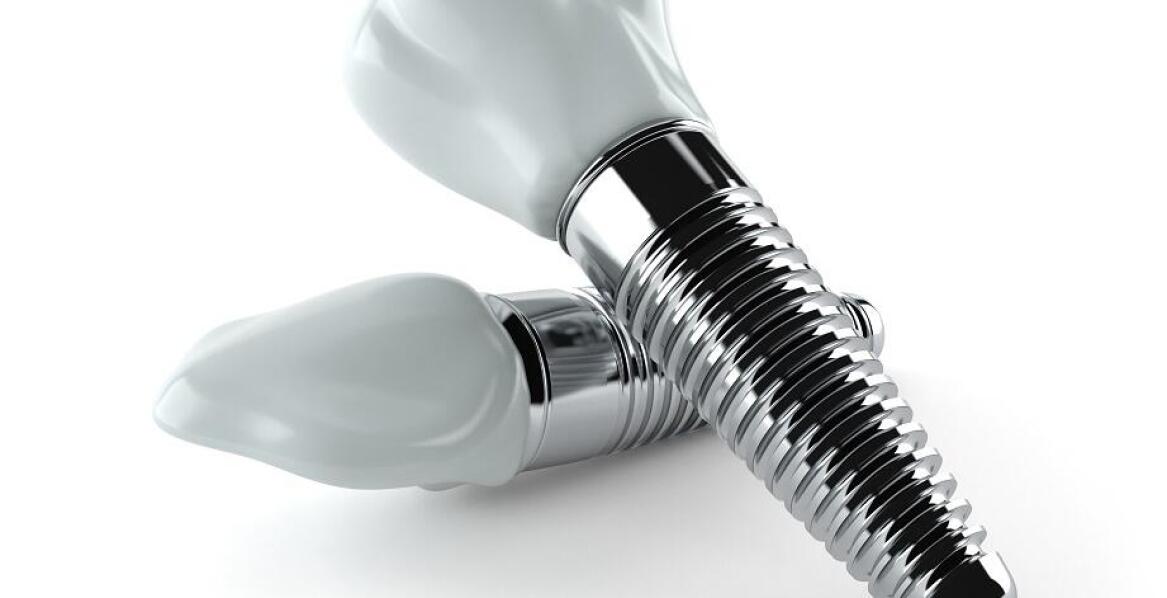 Dlaczego implanty zębowe są trwałym rozwiązaniem dla wielu pacjentów?