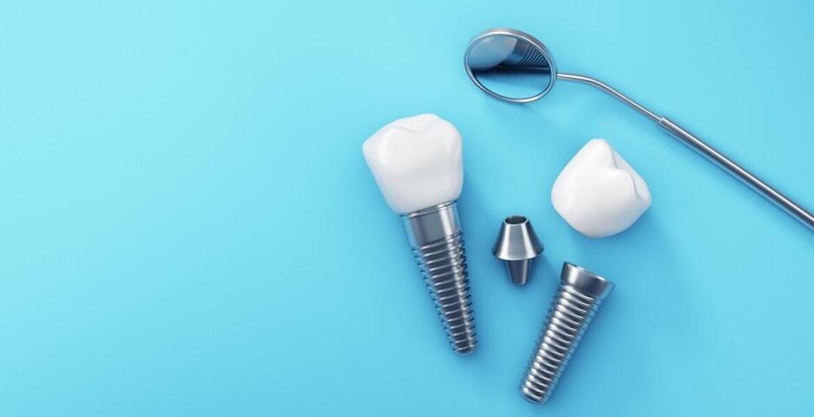 Jakie są najczęstsze pytania pacjentów dotyczące implantów? Odpowiada Dentysta Bochnia