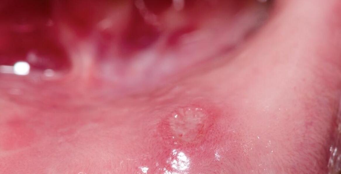 Torbiele w jamie ustnej: jak rozpoznać i leczyć problem chirurgicznie