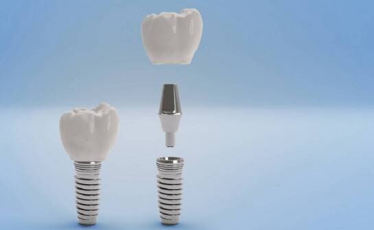 Implanty zębowe a inne metody uzupełniania braków zębowych