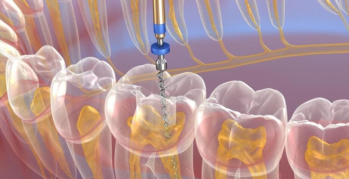 Bezbolesne zabiegi resekcji wierzchołka korzenia zęba dzięki nowoczesnym technologiom