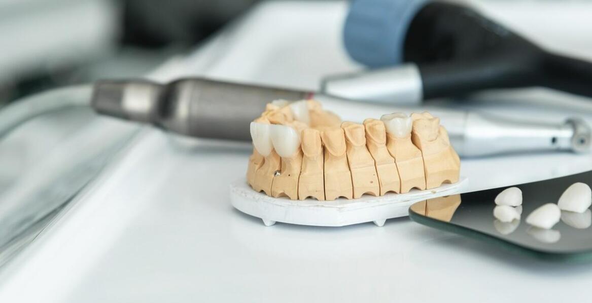 Czym różnią się implanty zębowe od mostów protetycznych?