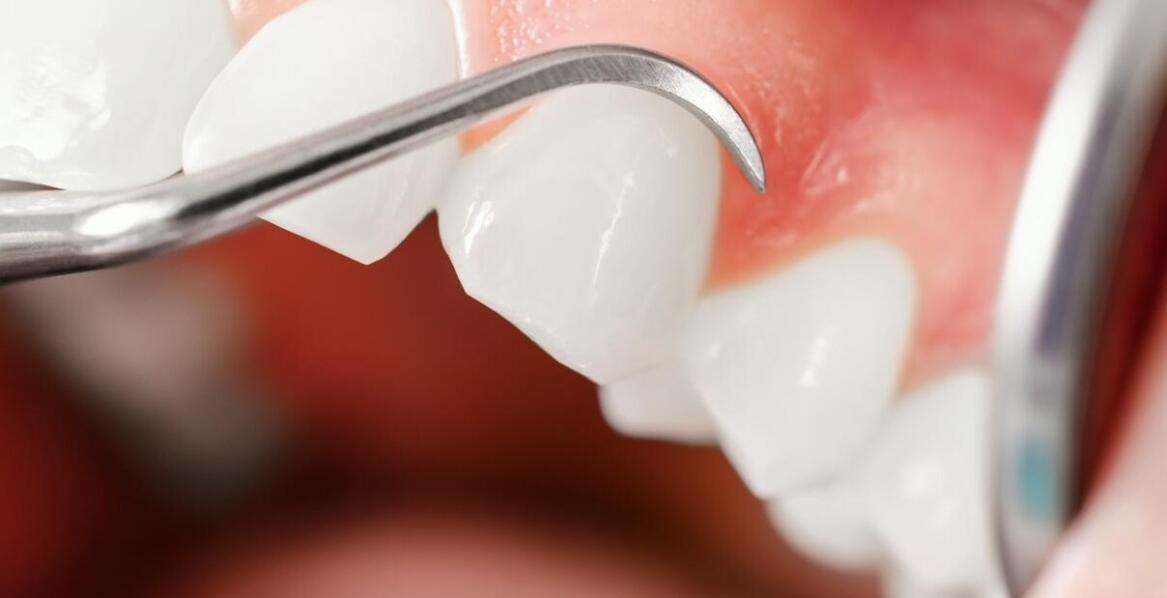 Proces gojenia po implantacji zębów: Kluczowe wskazówki dla pacjentów