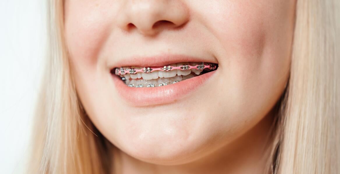 Jakie metody stosowane są w leczeniu ortodontycznym u dzieci?