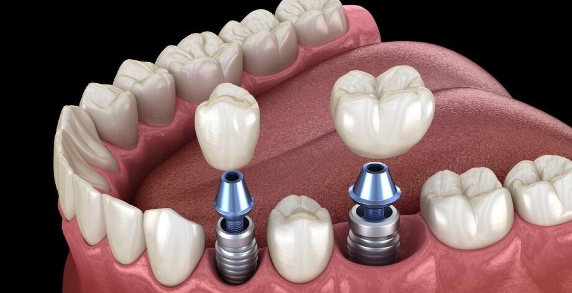 Dlaczego implanty zębowe są trwalsze niż tradycyjne protezy?