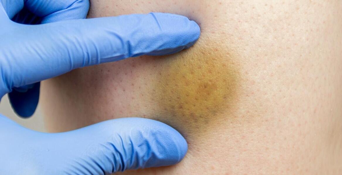 Jak hirudoterapia wpływa na redukcję stanów zapalnych w ciele