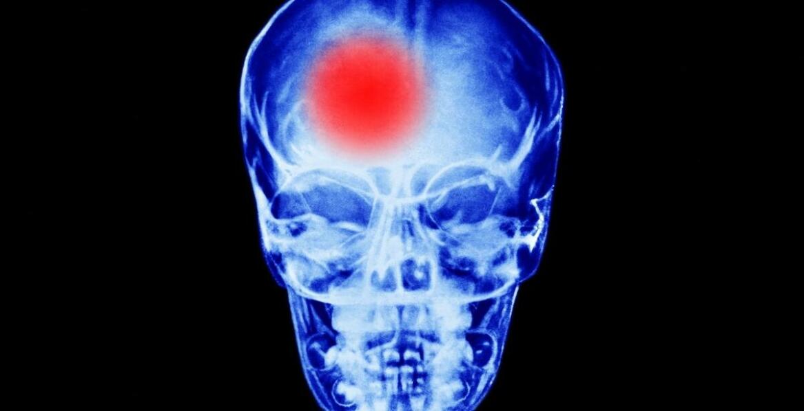 Wpływ guza mózgowej przysadki na wzrok – objawy i diagnostyka