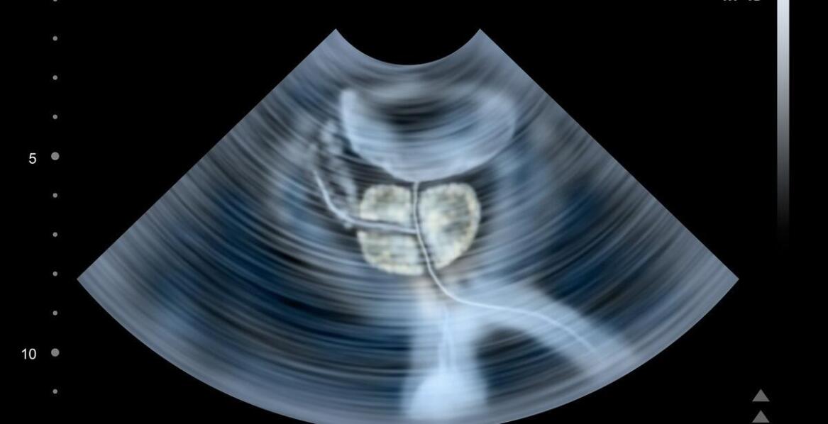 Kiedy operacja jest konieczna w przypadku guza mózgowej przysadki?