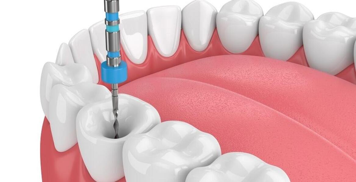 Jakie są etapy leczenia endodontycznego w nowoczesnej stomatologii?