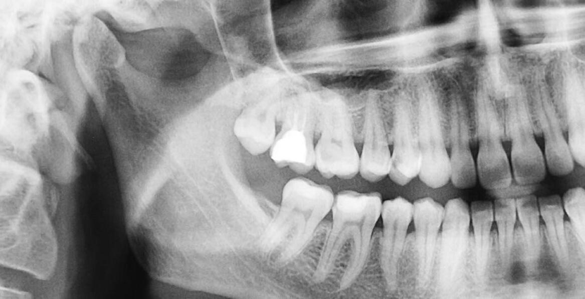 Wpływ dokładności pomiarów rentgenowskich na planowanie zabiegów