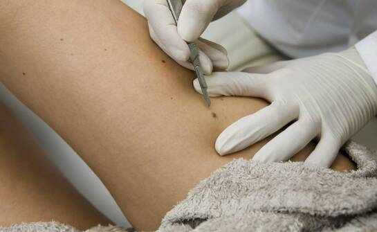 Jak wygląda przygotowanie do usuwania znamion barwnikowych?