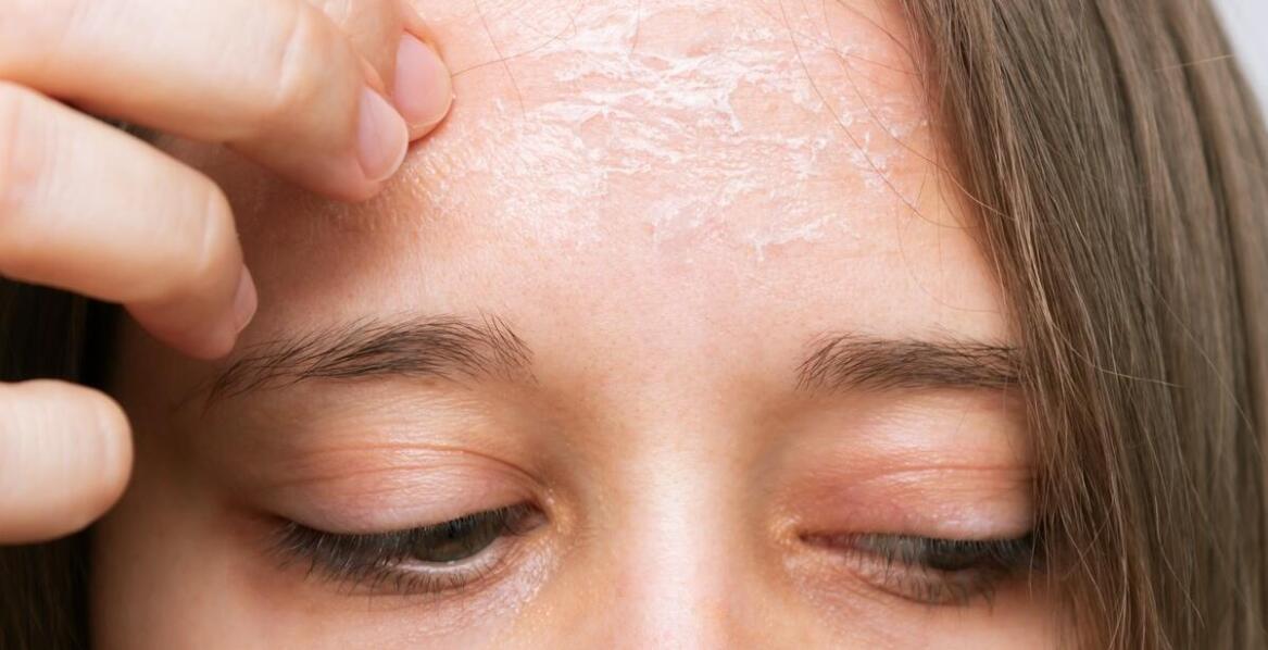 Wpływ środowiska na rozwój grzybicy skóry głowy: jak chronić się?