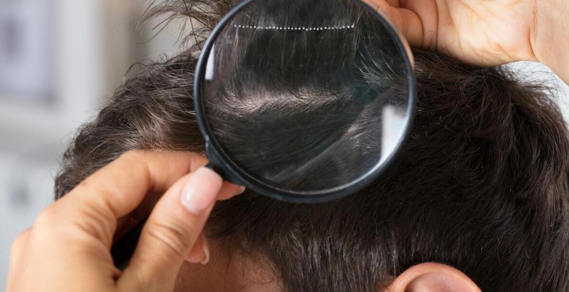 Jakie są objawy łupieżu Gilberta i kiedy szukać pomocy?