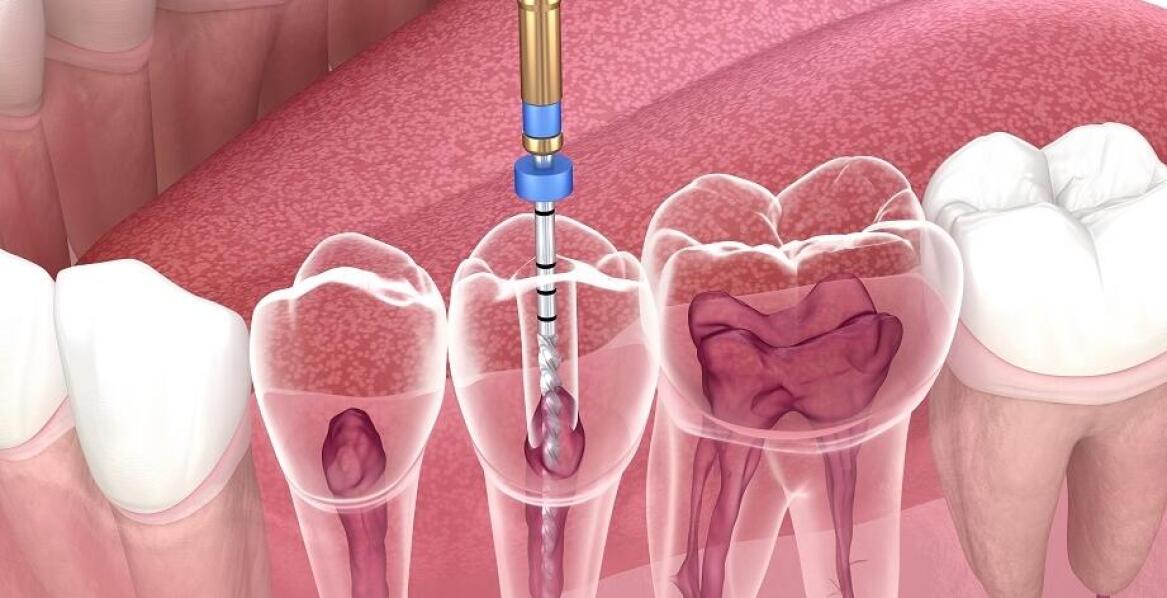 Proces leczenia kanałowego krok po kroku: co musisz wiedzieć