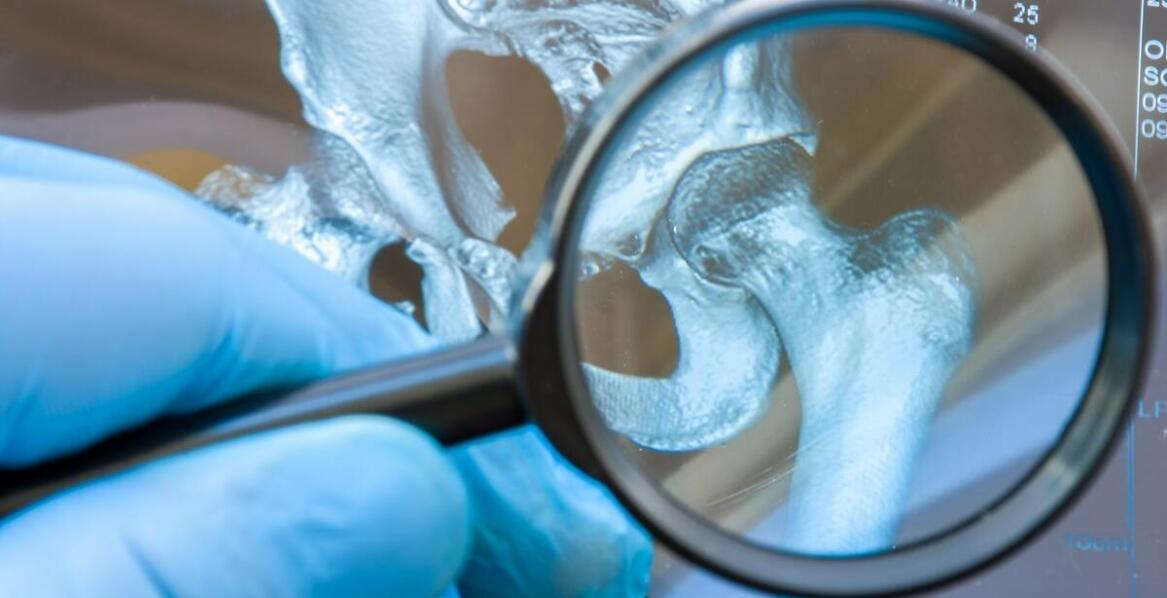 Osteoporoza – jak obrazowa diagnostyka wspiera leczenie?