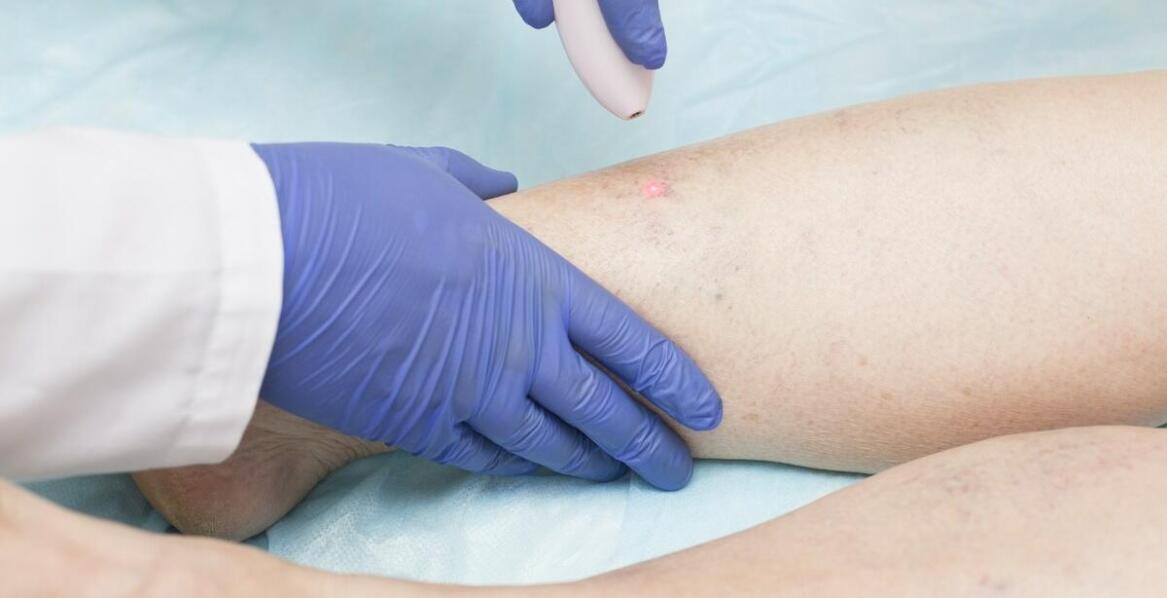 Zapalenie powierzchownych żył - jakie są pierwsze objawy i jak je rozpoznać?