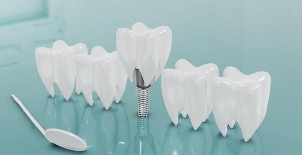 Jakie są możliwości estetycznej rekonstrukcji zębów z użyciem implantów?