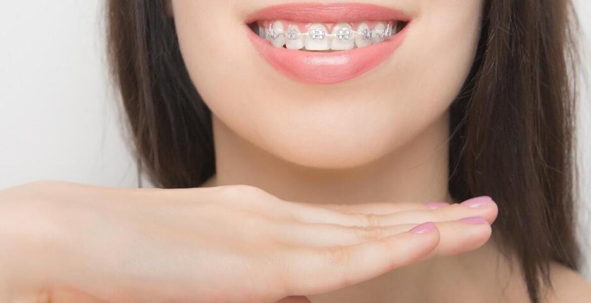 Jakie są dostępne rodzaje samoligaturujących aparatów?