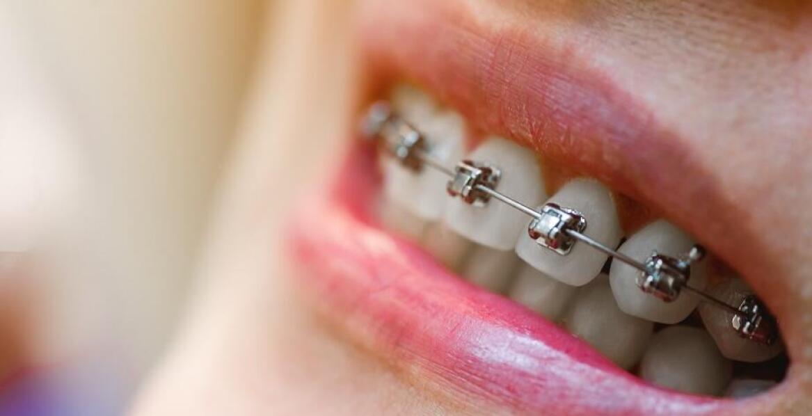 Jakie są różnice między metalowymi aparatami a estetycznymi?