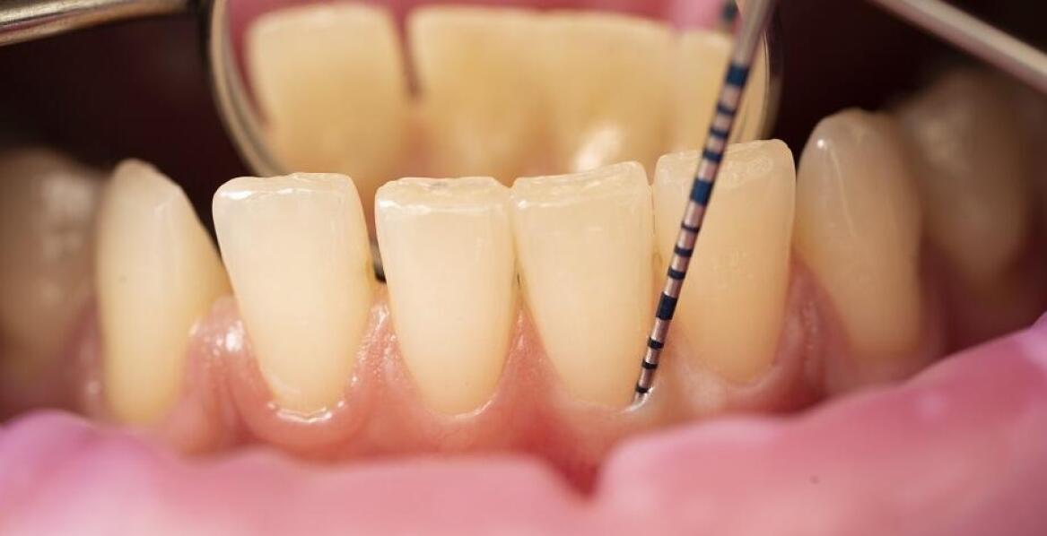 Periodontologia jako klucz do zdrowych dziąseł i kości szczęki.