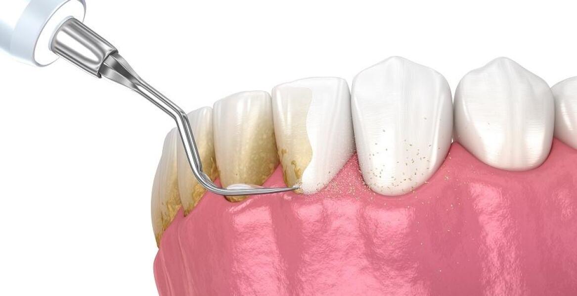 Skuteczność piaskowania i skalingu w profilaktyce stomatologicznej