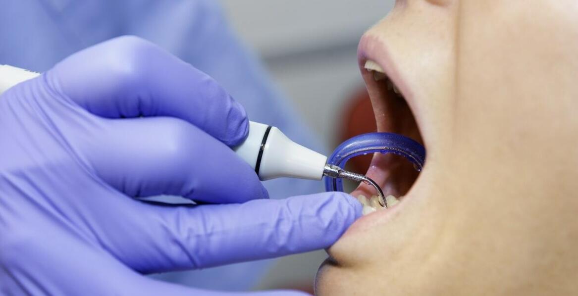 Maszynowe leczenie kanałowe – zastosowanie ciekłej gutaperki