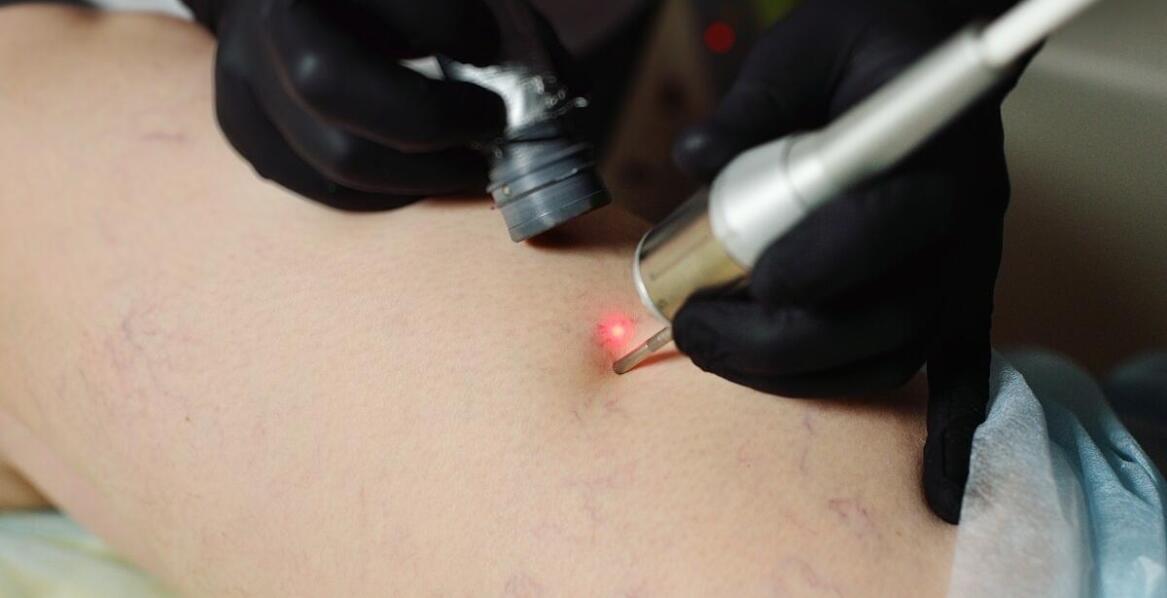 Usuwanie blizn po oparzeniach: jakie są najnowsze techniki w dermatologii?