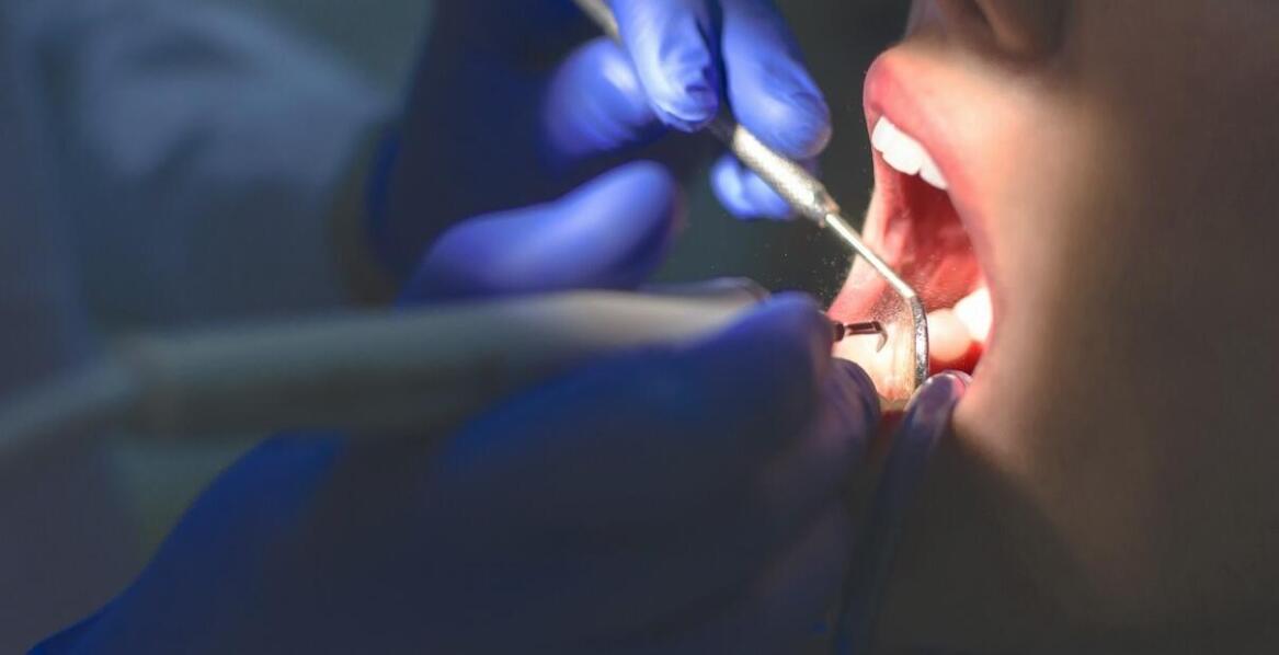 Usuwanie nazębnego kamienia – jakie są jego największe zalety?