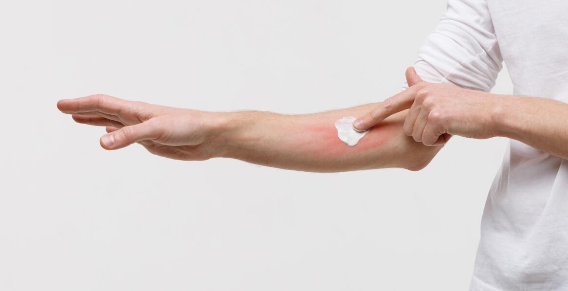 Zastosowanie lidokainy w maściach do oparzeń